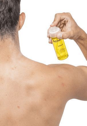 Спрей для тіла з акне &ndash; Acnemy Zitback, 80 ml 2171 фото